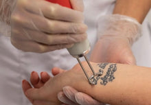 Load image into Gallery viewer, Laser Tattoo Removal
